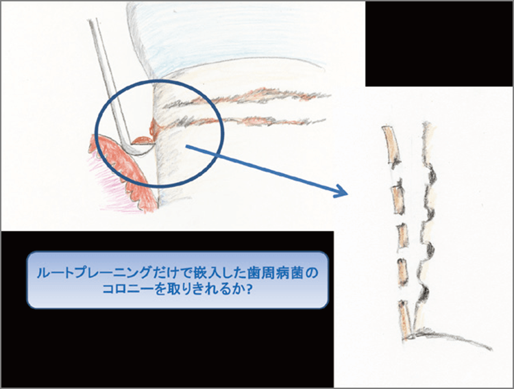 繊維痕の深さは恐らく個人差があるものと思われるが、それらがセメント質を越えて、より有機質成分の多い象牙質付近まで嵌入している可能性は否定できない。従来のルートプレーニングで完全に病巣を除去しきれるのかは甚だ疑問と言わざるを得ない。