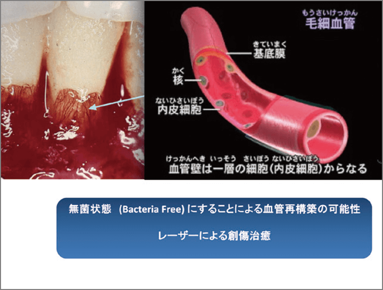 ポケット内がバクテリア･フリーになると、細菌性毒素や抗原に対する免疫応答が排除され、組織は一気に創傷治癒に転ずる。組織再生に強く関与する毛細血管が再構築され、破壊された歯周組織が治癒される。