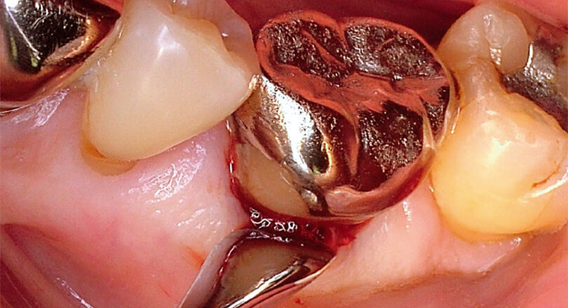 剥離子で歯肉を広げているが、この操作は必ずしも必要ではない。