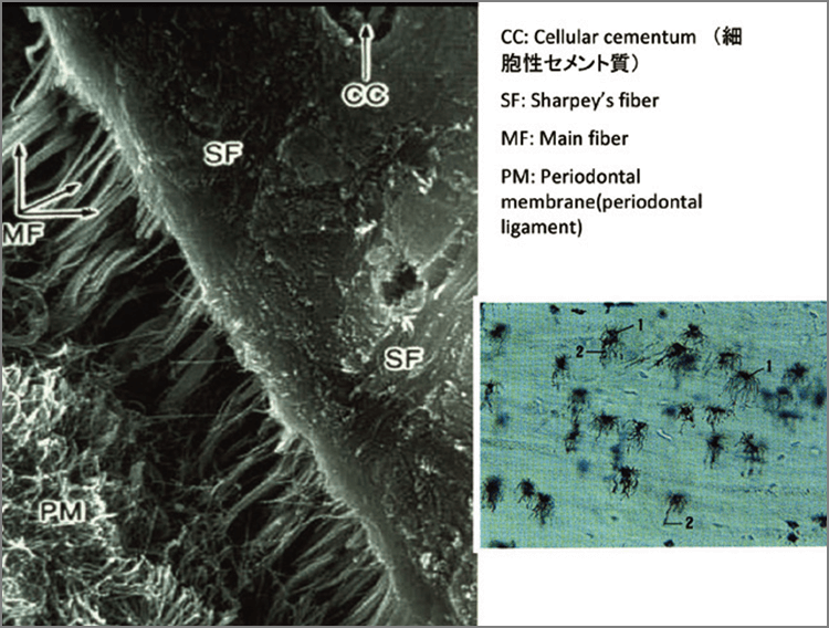 セメント質内にシャーピー繊維が嵌入している状態を示した電顕図。シャーピー繊維はセメント質内に深く嵌入し、その部分が祠状の窪みになっているのが分かる。歯周病の進行によって、歯槽骨が破壊されてゆく過程で、シャーピー繊維も喪失してしまうが、喪失した部分は直接歯肉内縁と接触し、その間に病原性の強い歯周病菌を含むプラークが介在し、結果としてこのような歯根膜が嵌入していた窪みが歯周病菌の格好の住処となる。