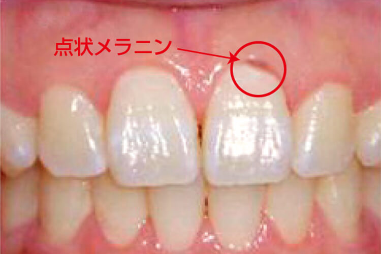症例4 26歳、女性　歯頸部の点状メラニン