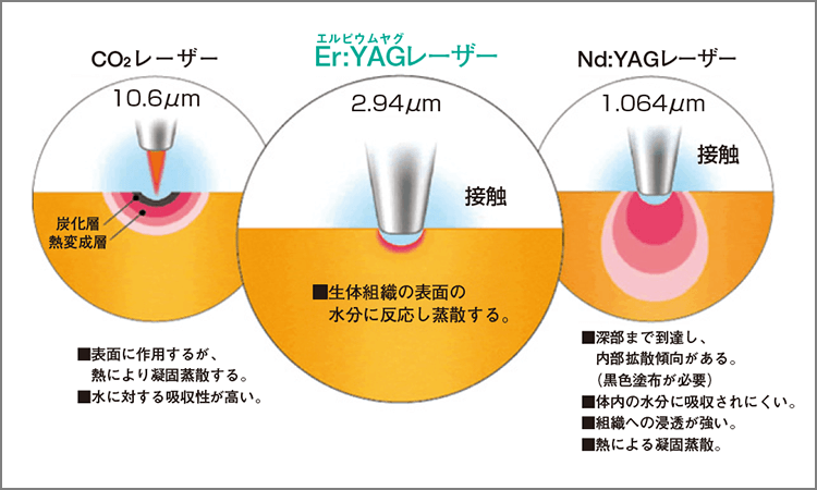 Er：YAGレーザーは生体の表面の水分に反応