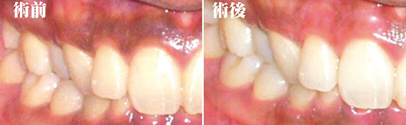 口腔内様相の変化　左：術前　右：術後
