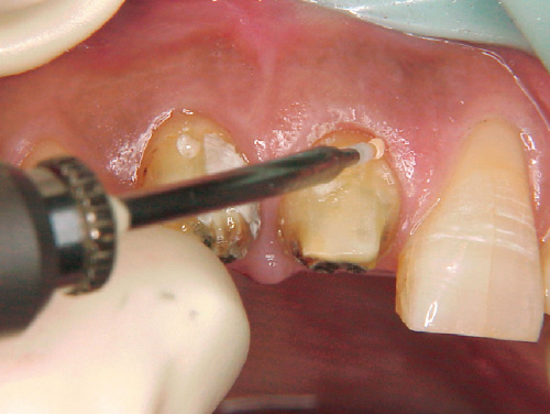 レーザーによる歯肉修正の写真