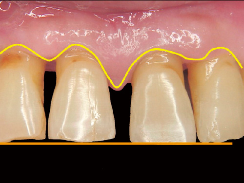 歯肉のライン写真