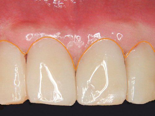 歯肉と歯冠調和の写真