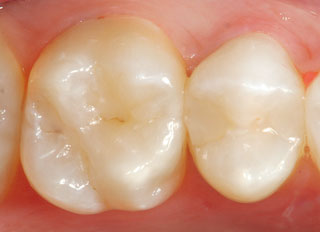 上顎大臼歯の咬合面観の術前写真