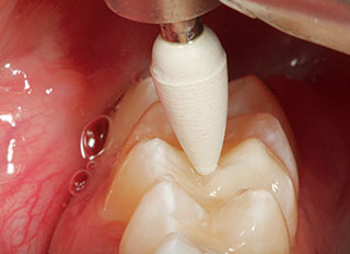 ダイヤモンドコンポジット研磨器で隣接領域を滑らかにするシーン