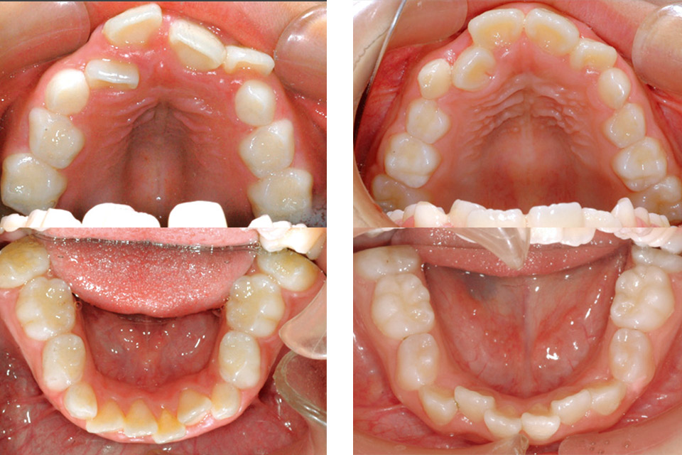 図1　小学生児童の叢生歯列