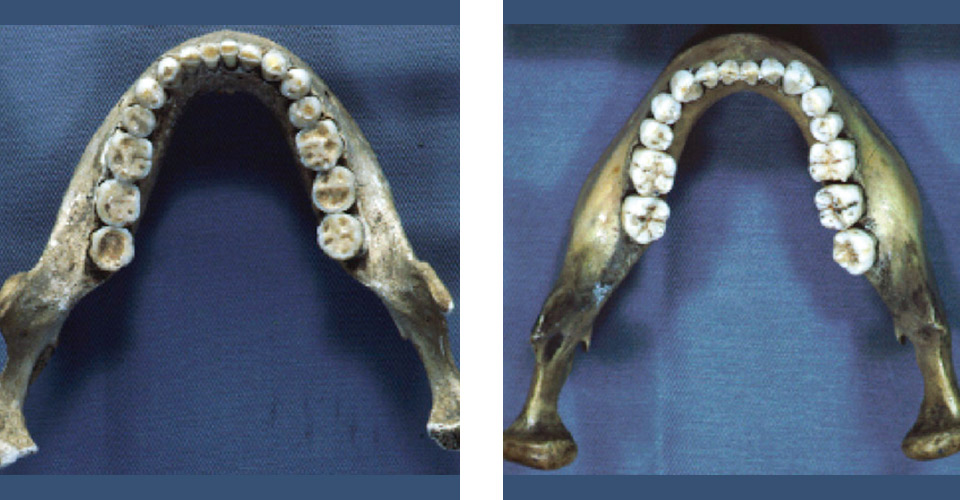 図2 縄文時代人（左）と現代日本人（右）の歯列