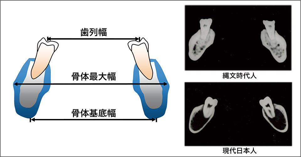 図3 CTによる縄文時代人と現代日本人の下顎体垂直断（下顎第二大臼歯）