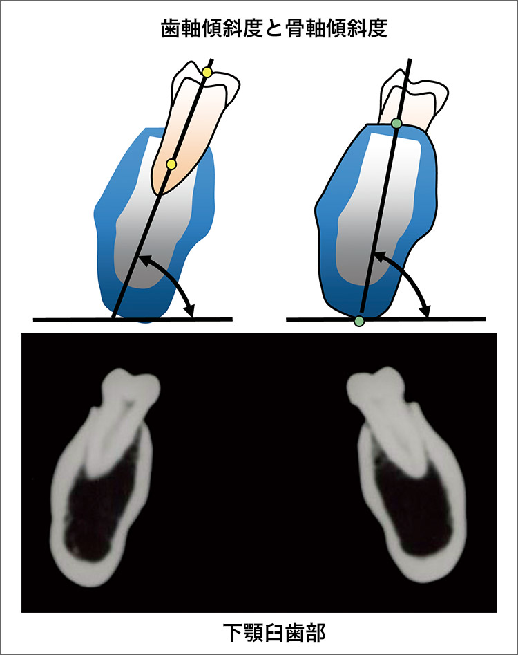 図4 下顎臼歯部と歯軸傾斜と骨軸傾斜