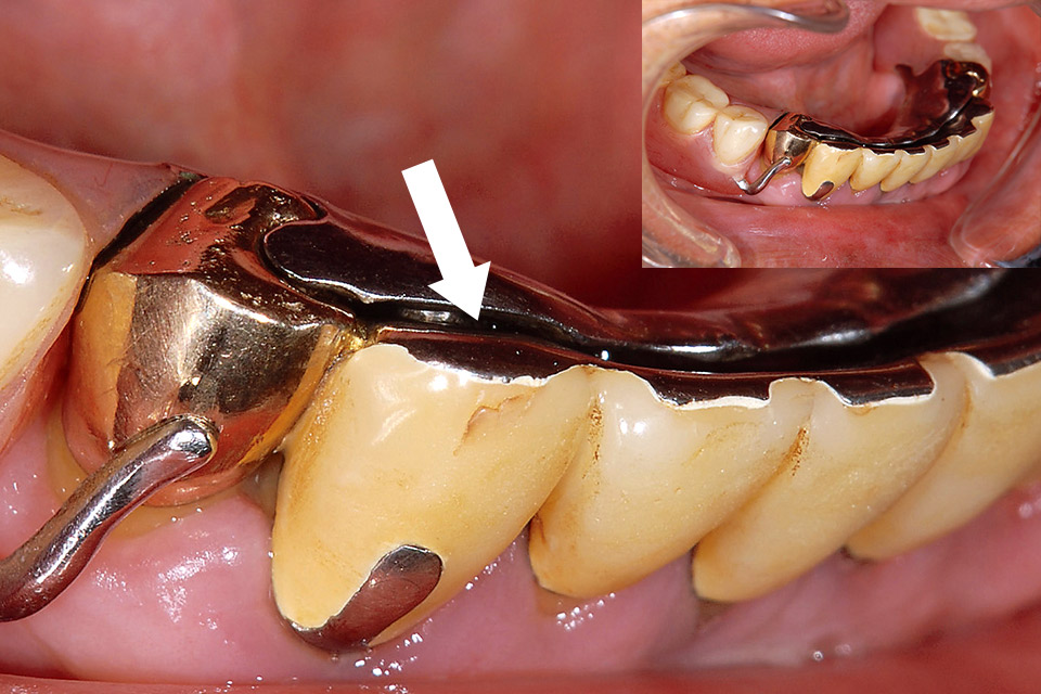 図1-a 両側臼歯にて咬合すると無歯有床部が沈下して前歯部が不適合となる。