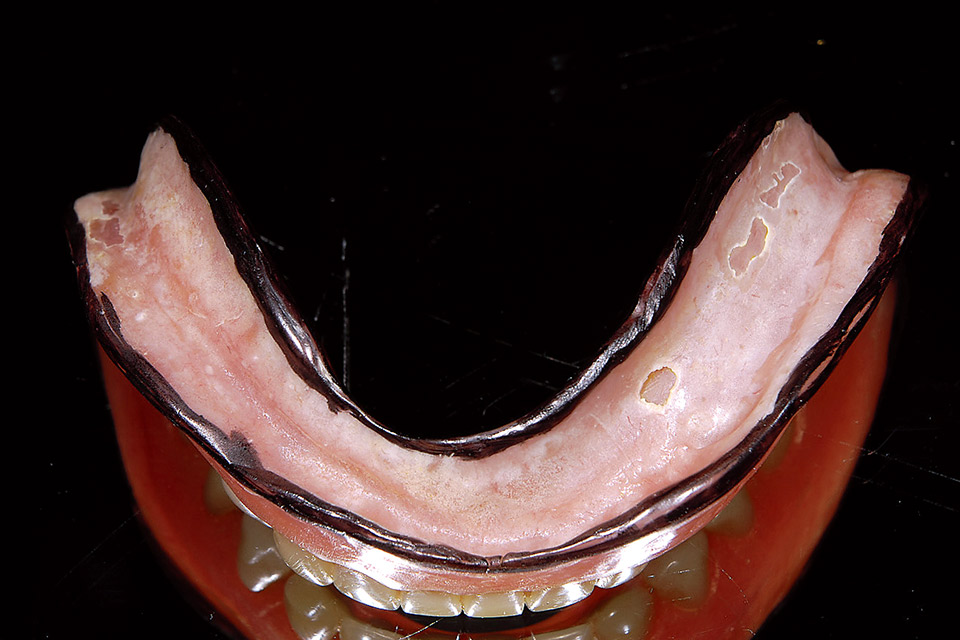 図10　義歯ボーダー部分は義歯不安定を惹起する可能性があるので削除する（黒色部）。