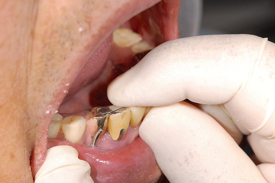 図4　手指にて前歯部が適合する位置にて口腔内でホールドしながらボーダー採取する。