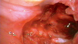 抜歯窩の写真