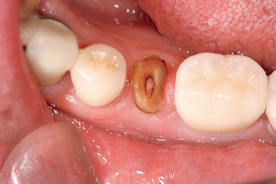 図21　下顎右側第２小臼歯の支台築造のための支台歯形成