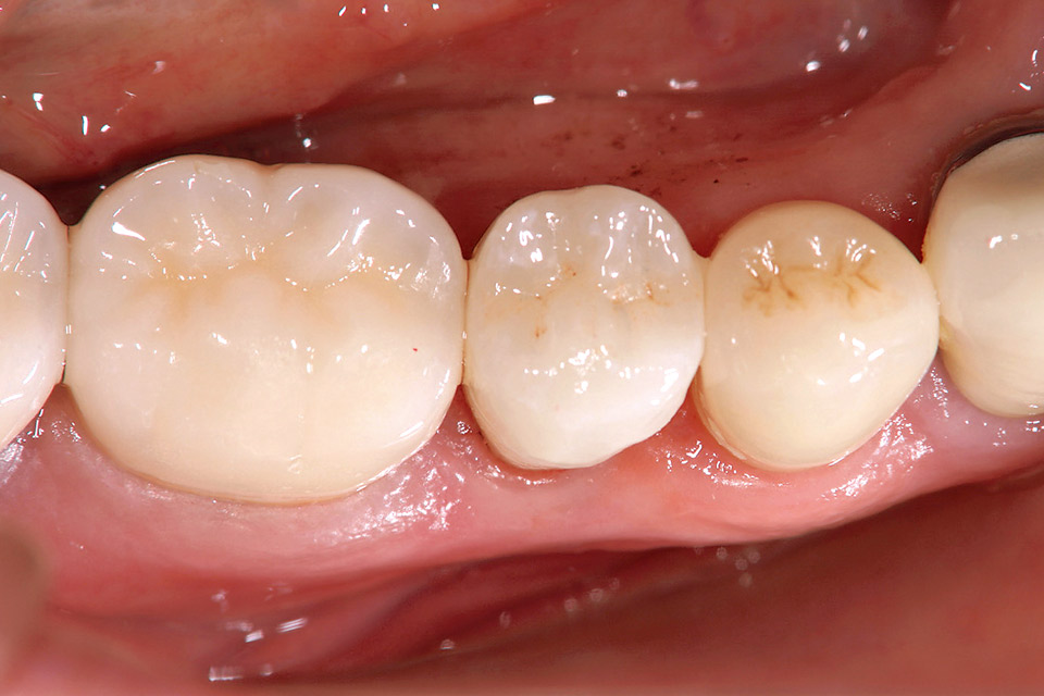 図24　オールセラミッククラウン装着後