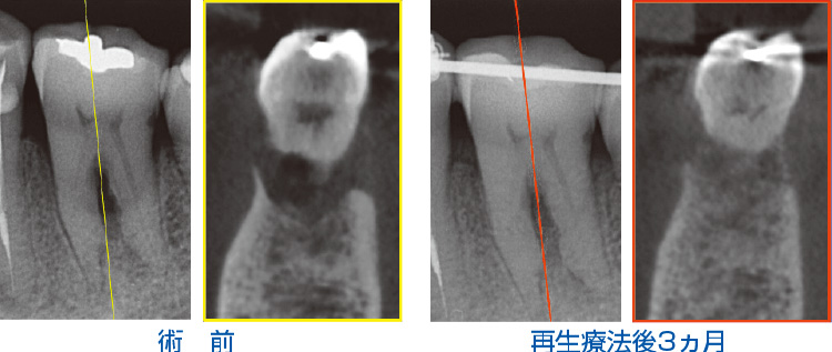 コーンビームCTによる3次元画像診断写真