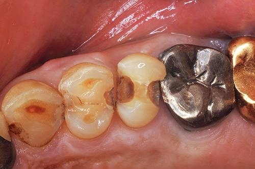 インレーとう蝕部分を除去した写真