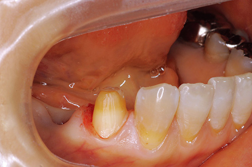 ブリッジの支台歯として生活歯を形成した写真