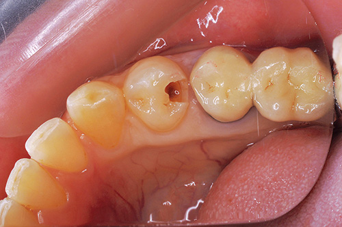 咬合面から隣接面に至るう蝕の写真