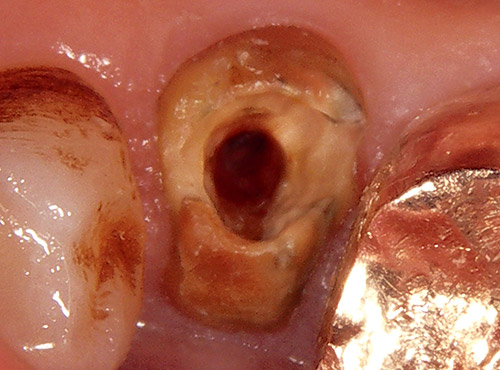 変色した象牙質の除去後の同部位の写真