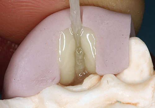 コアレジンを盛り付けておいたシリコーンコアを作業用模型に適合させる写真