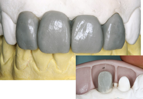 修復部位の歯冠形態を回復し、シリコーンコアを採得した後、コアを参考に築造体部のワックスアップを行った写真