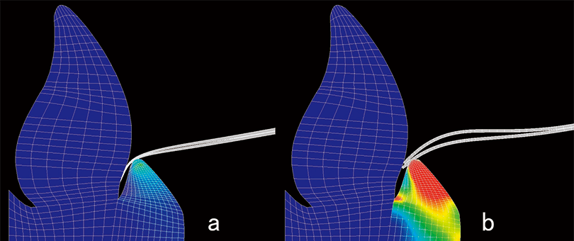 有限要素法による歯肉溝モデルでの毛先侵入の際の応力の解析　a：高度テーパードブラシ、b：テーパードブラシ　高度テーパードブラシの応力は、テーパードブラシの約1/6であった。