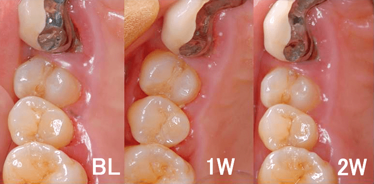 実験側の歯肉の経時的変化