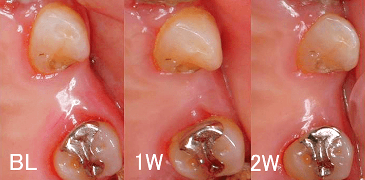 対照側の歯肉の経時的変化