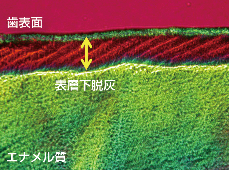 う蝕は、歯面の最表層ではなく、表層下10から20μmの部分の脱灰から始まる（表層下脱灰）。