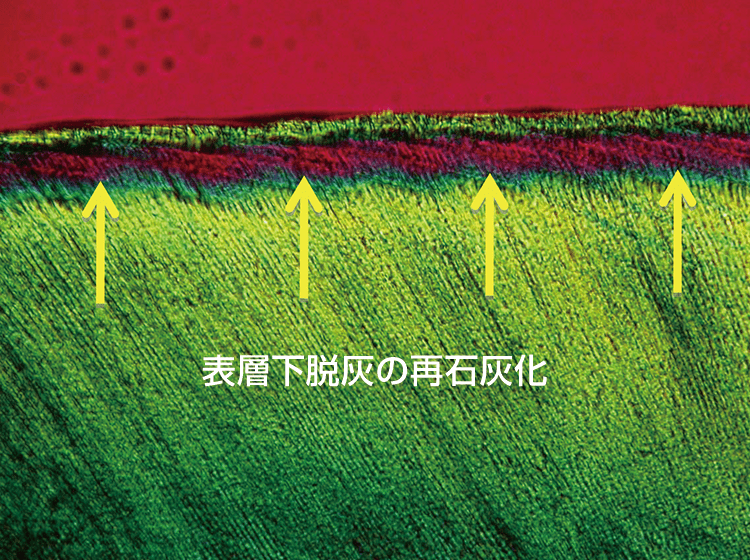 表層下脱灰は、適切なプラークコントロールやフッ化物塗布などで確実に再石灰化して行く。