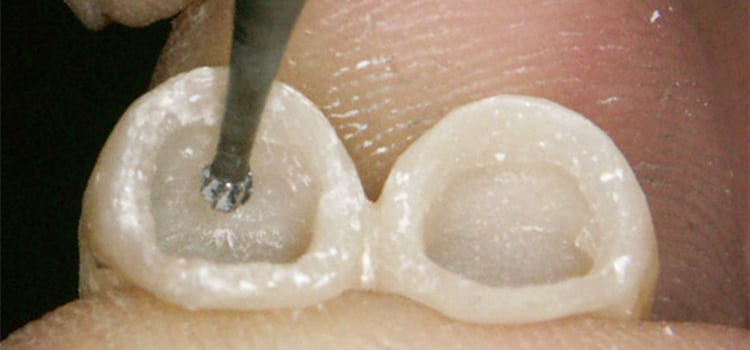 プロビスタを用いた簡単な審美回復法。支台歯のディスカラレーションがある場合、暫間補綴物を作製後、審美エリアの内面をラウンドバーにて一層削去。