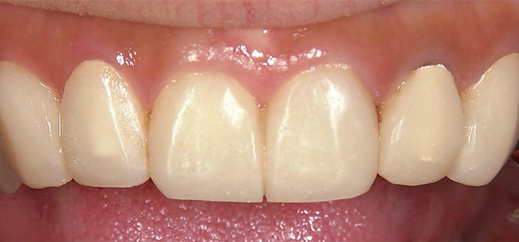 側切歯には切端付近にディスカラレーションはあるが、オペークアイボリーを用いた中切歯にはない。