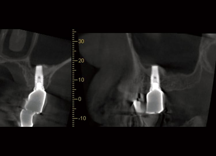 術後のCT像。頰舌的に十分に拳上がなされインプラント周囲に十分な骨量が観察される。