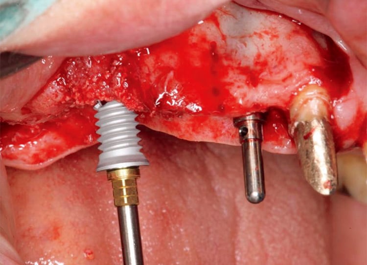 インプラント埋入中の状態。