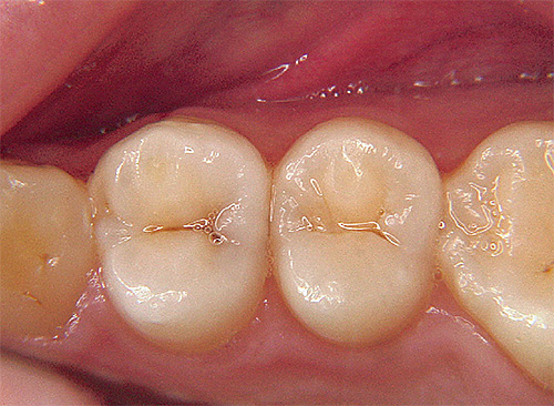 第一小臼歯隣接面の写真