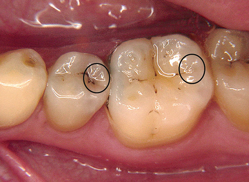 第二小臼歯遠心と大臼歯遠心の写真