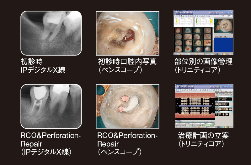 パーフォレーション（穿孔）のケース