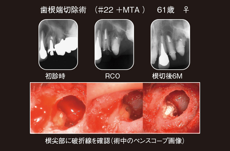 歯根端切除術のケース