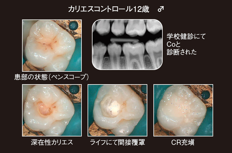 カリエスコントロールのケース