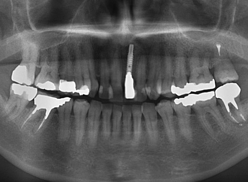 最終補綴装着後のパノラマＸ線写真