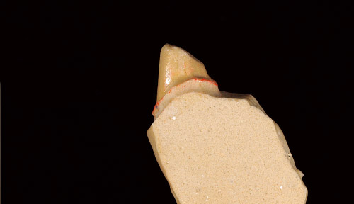 支台歯、切縁部の厚みが1.0ｍｍ以上あることを確認する写真