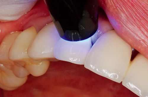 余剰セメント除去後にマージンに光照射する写真