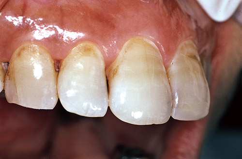 前歯部3級の症例の術前写真
