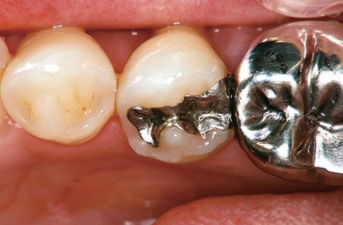下顎小臼歯部2級の症例の術前の写真
