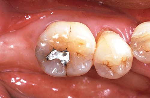 下顎大臼歯部１級の症例の術前写真