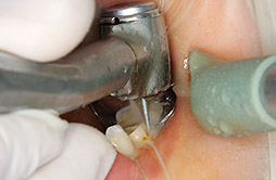 頰側面歯頸部の形成の画像